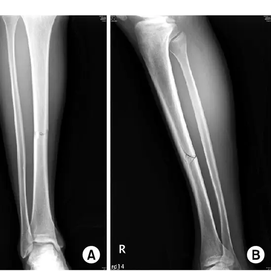 X-ray RIGHT LEG AP & LAT